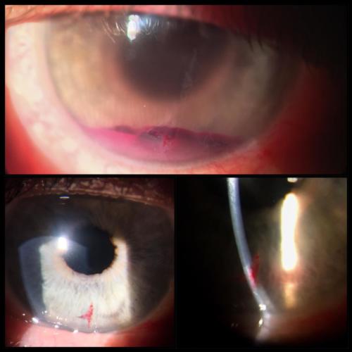 Penetrating trauma of the cornea
